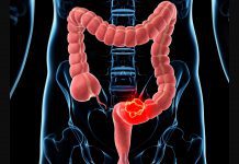 Cáncer de colon: una patológica común pero tratable